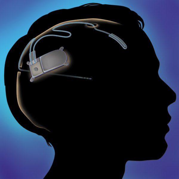 NeuroPace,имплант, Создан имплантат для контроля работы головного мозга