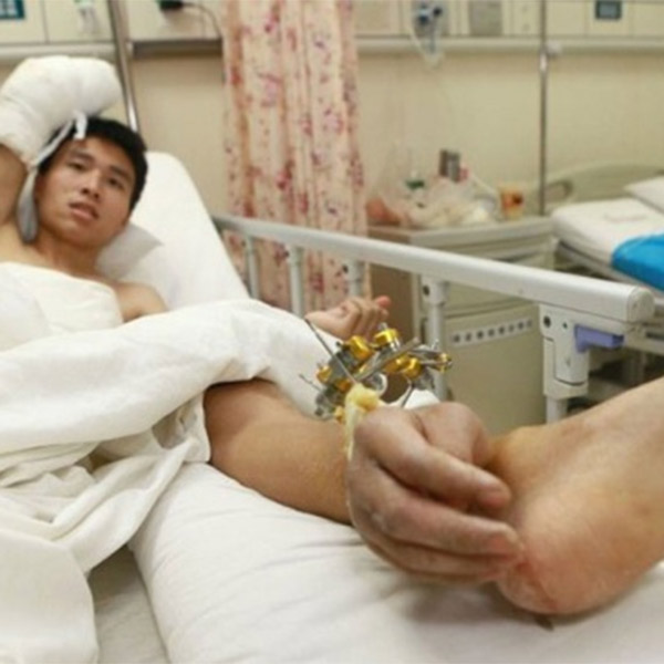 медицина, Китайские хирурги спасли кисть пациента, пришив ее… к ноге