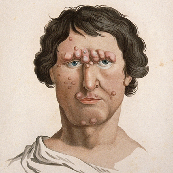 Медицина,иллюстрации, Пугающие медицинские иллюстрации 19 века